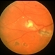 Retinal Capillary Hemangioma
